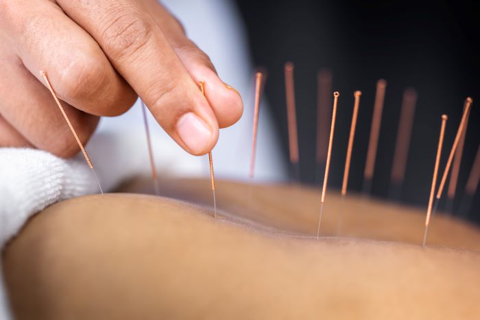 Acupuncture Treatment Sarasota FL